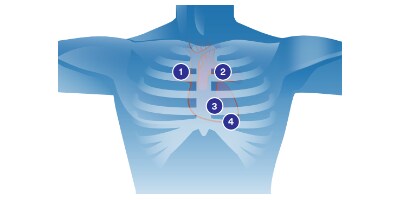 Diagramm Auskultation des Herzens
